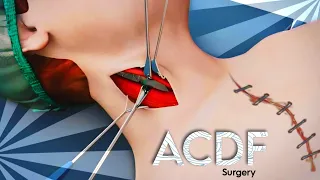 ACDF (Anterior Cervical Discectomy and Fusion) 3D Animation