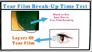 Tear Film Break-up Time Test (Within 1:30 min)