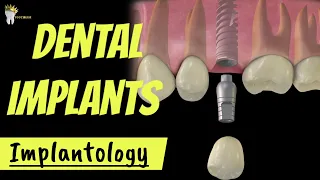 DENTAL IMPLANTS : INTRO and ADVANTAGES, OSSEOINTEGRATION EXPLAINED