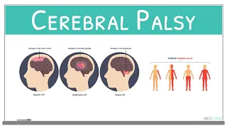 Cerebral Palsy classification, causes, signs and symptoms and treatment