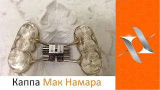 Ортодонтический аппарат (каппа) Мак Намара. Оrthodontic appliance McNamara.