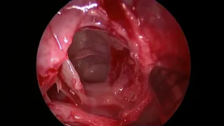 Video 5: Gate 3 - Ground Lamella of the Middle Turbinate