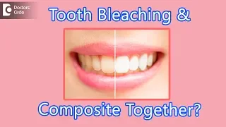 Is it safe to go for composite fillings and tooth whitening simultaneously? - Dr. Aniruddha KB