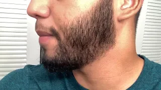 Using Minoxidil to grow a Beard| Month 16!