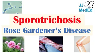 Sporotrichosis (Rose Gardener’s Disease): Causes, Risks, Types, Symptoms, Diagnosis,  Treatment