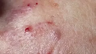 SAC DEP SPA Blackheads | #623