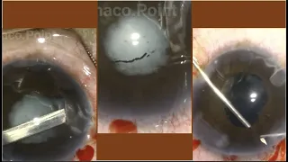 Surgical management of a case of total cataract with post uveitis sequelae- some pearls