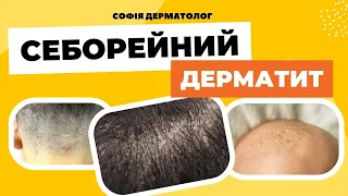 Лікування СЕБОРЕЙНОГО ДЕРМАТИТУ. Чим шкідливі пілінги? Софія Дерматолог. Як позбавитись ЛУПИ?