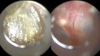 132 - Eardrum & Ear Canal Dead Skin Peel using the WAXscope®️ & latest AutoFocus Feature!