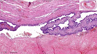 Ectopic Pregnancy - Histopathology