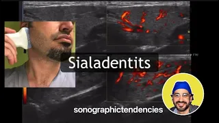 Sialadenitis