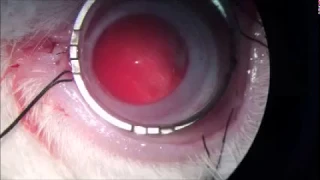 Murata Eye Clinic, Intra-choroidal implant insertion through sclera in optic disc - macula area