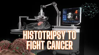 Histotripsy: The Future of Cancer Treatment Unveiled