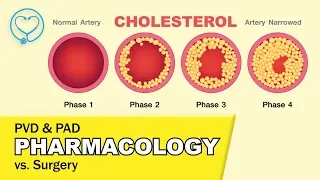 PAD vs  PVD animation   TOP 3 tested pharmacology treatments & Surgery   memory tricks for NCLEX rev
