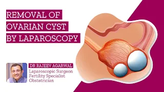 Laparoscopic Removal of an Endometriotic Cyst I Dr. Rajeev Agarwal