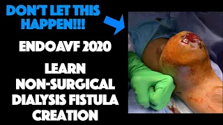 Percutaneous Dialysis Fistula Creation (EndoAVF) Basics 2020