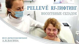 Радиоволновой Pellevé RF-лифтинг носогубных складок, врач дерматокосметолог А.В.Васина Интермедцентр