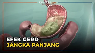 Efek Jangka Panjang GERD Jika Tak Segera Ditangani