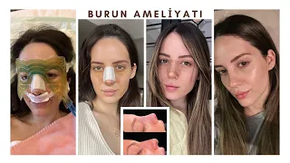 Burun Ameliyatı Sürecim👃🏼 En Acısız Burun Ameliyatı! Neler Yaşadım?