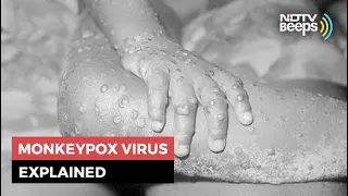 Monkeypox: 5 Things You Should Know About This Rare Virus