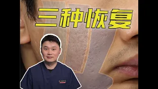 一个脸颊却有三种不同的恢复情况?Three different types of acne scars on one man's face