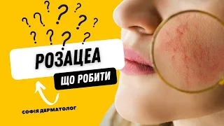 Розацеа. Лікування, симптоми. Поширені помилки у догляді за обличчям. Лікар-дерматолог. Одеса