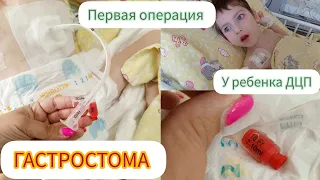 Гастростома баллонная🥺/ Установка и кормление 🤔/ Первая операция 😔29.05.24 г.