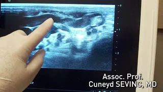 Varicocele Doppler Ultrasound Must Be Done in Standing Up Position - Cuneyd SEVINC, MD