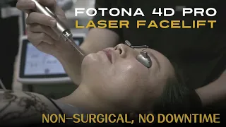 Fontona 4D Pro Laser Facelift 【BHPS】