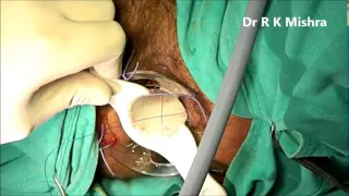 Stapled Hemorrhoidectomy or Minimally Invasive Procedure for Hemorrhoids