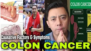 NURSE EXPLAINS | Ginebra Basketball Athlete L.A. TENORIO'S Stage 3 Colon Cancer Cause & Symptoms