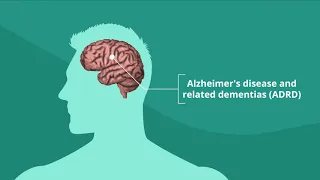 Novel Approach to Treat Alzheimer’s Disease: DREAM Study Perspective
