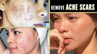 9 Ways To Treat Acne Scarring (Health Solutions)