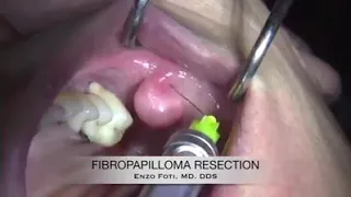 Fibropapilloma resection 😝😝