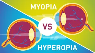 Difference between Myopia (Near Sightedness) & Hyperopia (Far-Sightedness)