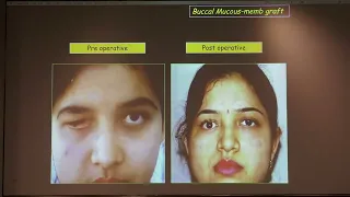 AIOC2022 GP122 topic Dr  Mrs  KASTURI BHATTACHARJEE  Oculofacial Reconstruction   Grafts and Flaps