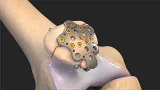 SuturePlate™ II Patella Fracture Repair System