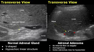 Adrenal Gland Ultrasound Normal Vs Abnormal Image Appearances | Cyst, Adenoma, Pheochromocytoma USG
