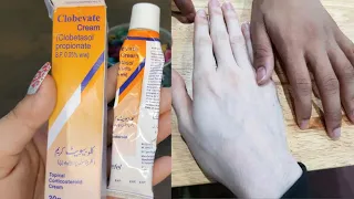 Clobevate cream for whitening/hand and foot whitening cream |clobevate cream