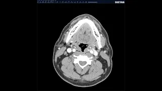 How to read CT neck soft tissues