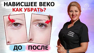 Нависшее веко. Как поднять верхнее веко без операции? Доктор Федчук