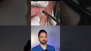 Doctor Explains CRAZY Blackhead | Doctorly #shorts