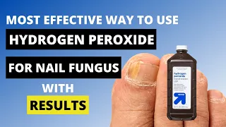 3 Ways to Use Hydrogen Peroxide for Nail Fungus - Toe Fungus Journey