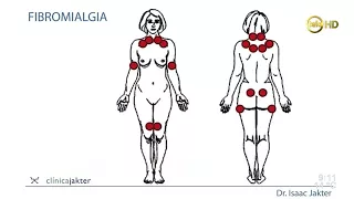 El dolor en la fibromialgia - Dr. Isaac Jakter