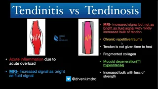 Tendinitis VS Tendinosis - Simplified