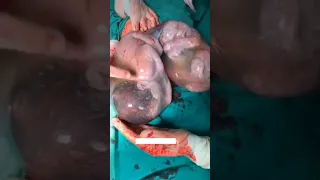 Twins Baby Delivery by Operation | Lscs Operation | Twins Baby Delivery  Baby Delivery | Physio Raza