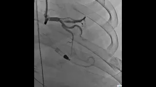 Coronary Angiogram Showing 95% Stenosis of the Distal LMCA and LCX in Right Anterior Oblique View