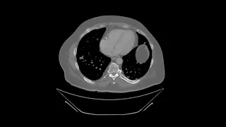 Bone Scintigraphy II : Introduction to Fractures and Metastases