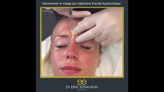 Harmonisation du visage par injections d'acide hyaluronique par le Dr Eric Essayagh sur Antibes