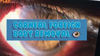 Corneal Foreign Body Removal | Ophtha